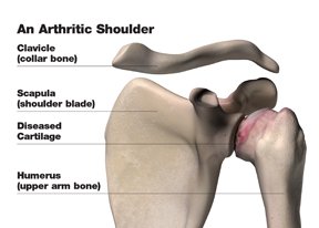Arthritic Shoulder