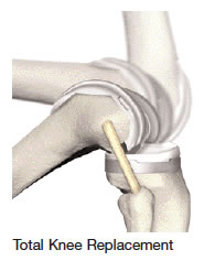 Total knee replacement